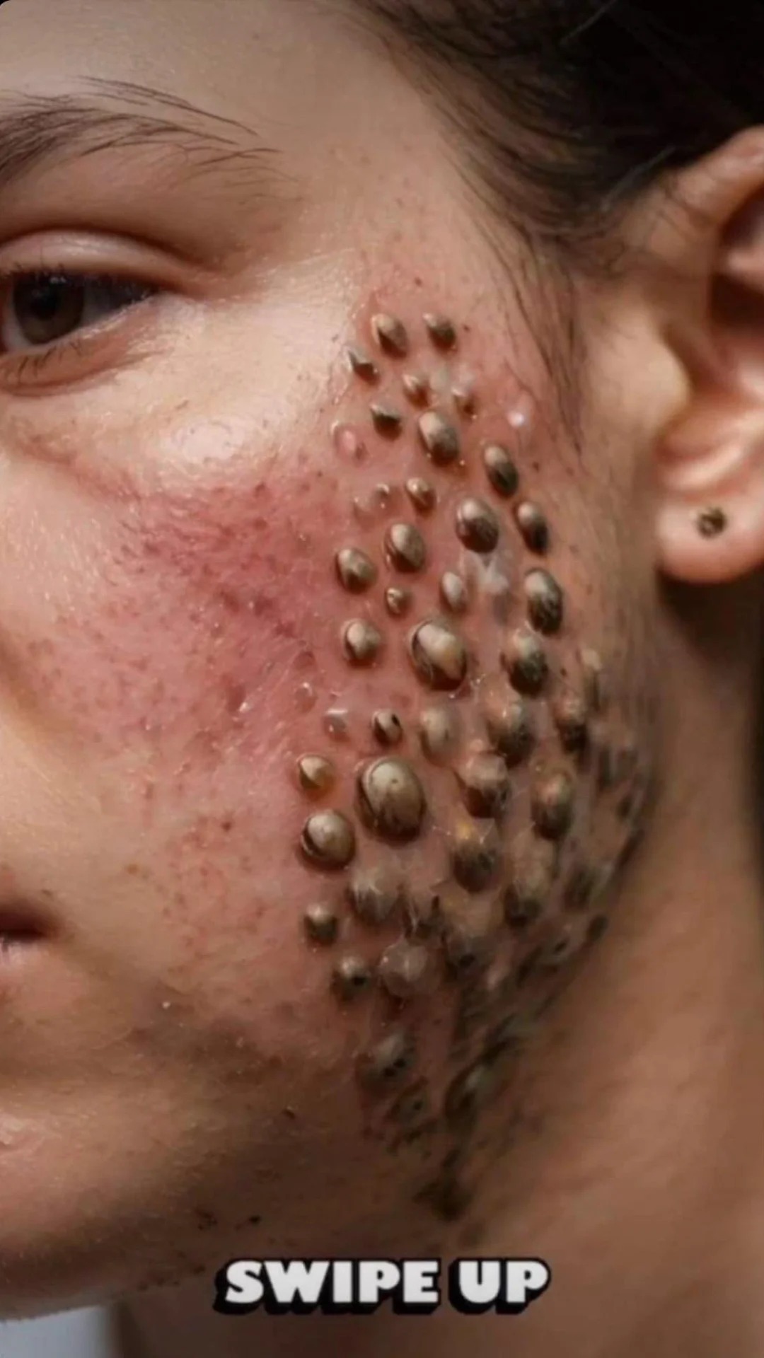 BODY ACNE: TIPS TO ELIMINATE IT