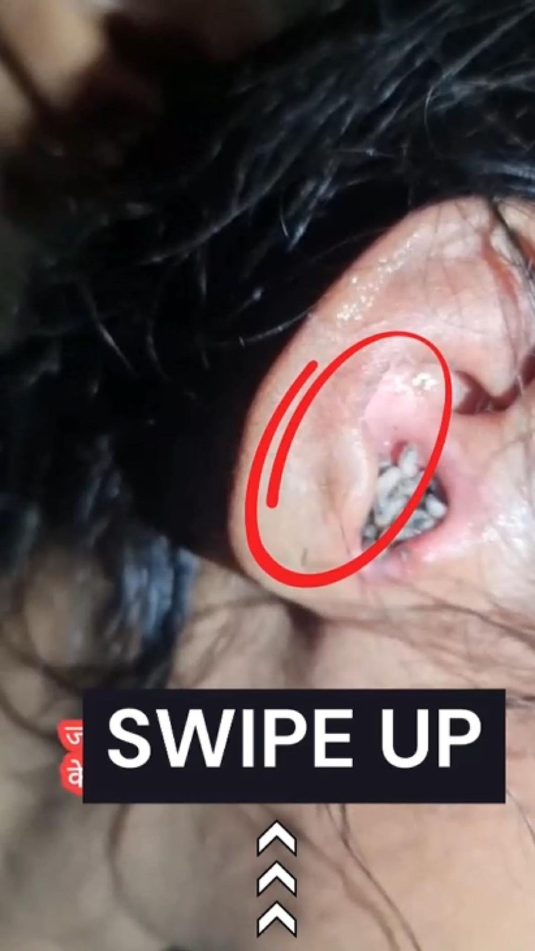 Maggots in ear