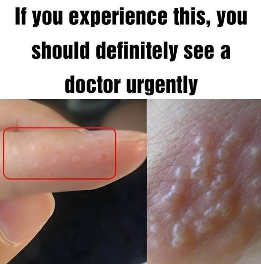 If You Notice Painful Red Bumps, You Might Have Dyshidrotic Eczema..