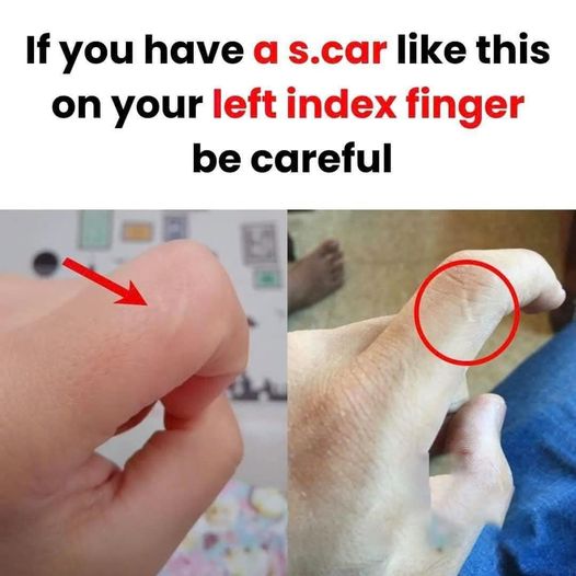Be Careful If You Notice This Scar on Your Left Index Finger..