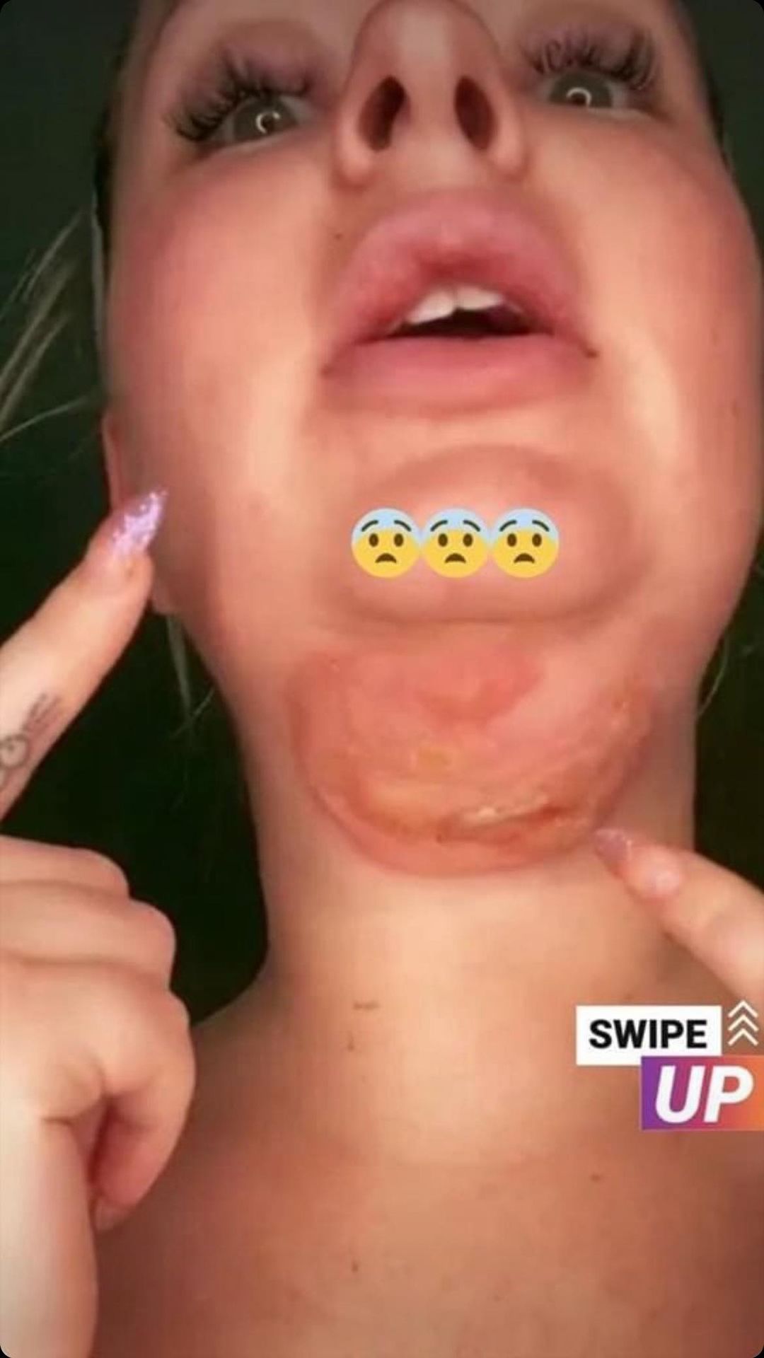 I got second-degree burns from jaw-sculpting surgery to give me a thinner face, I might be scarred for life & can’t talk