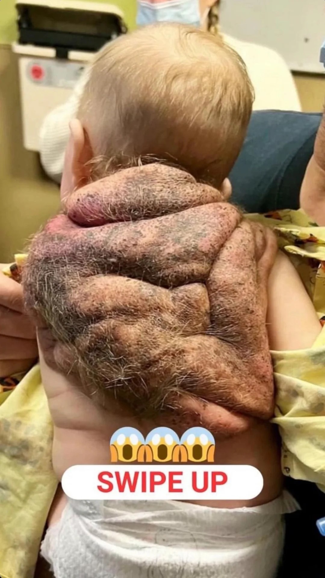 My ‘Ninja Turtle Baby’ Boy Was Born With a Shell — He’s My Superhero