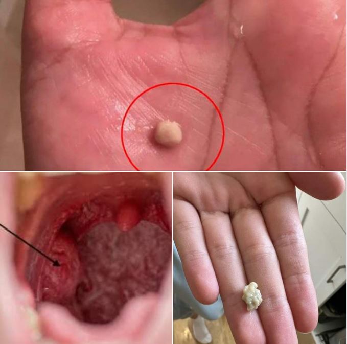 Here’s what you need to know about tonsil stones – the weird pimple-like growths in your throat