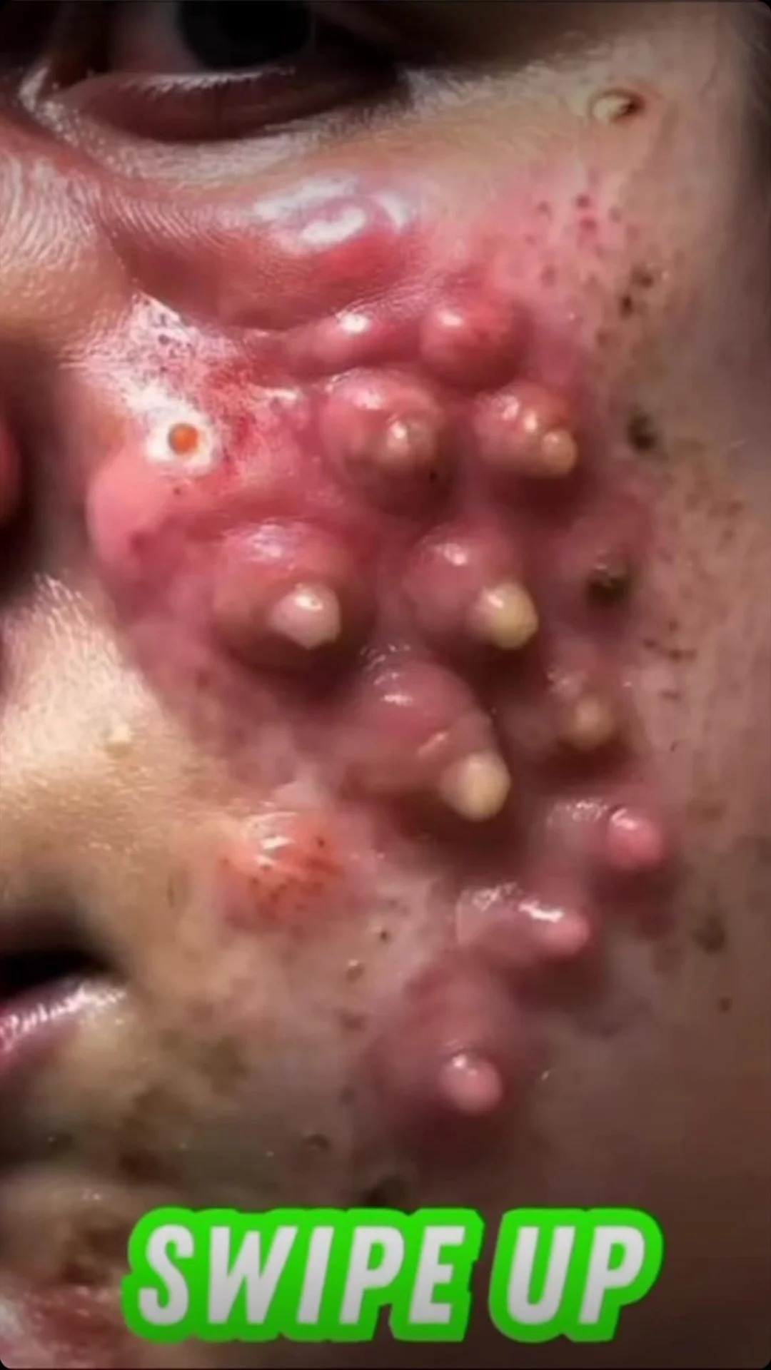 What does cheek acne look like?