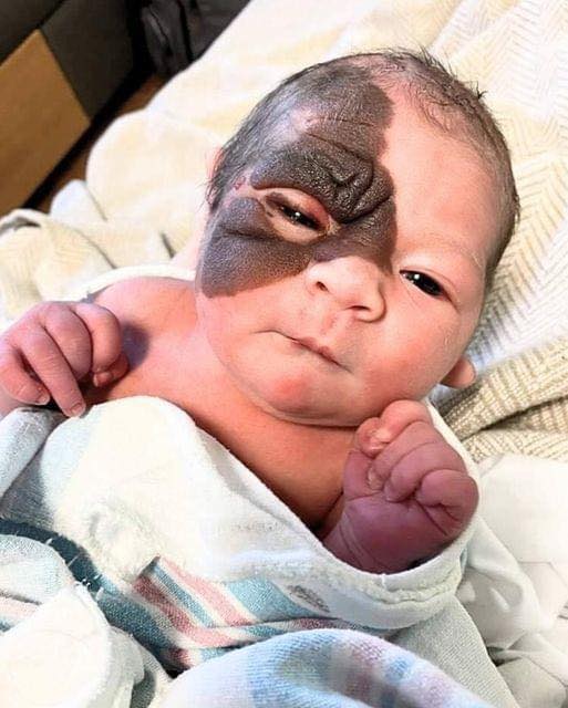 Mom on a mission to show daughter with extremely rare birthmark that she is beautiful