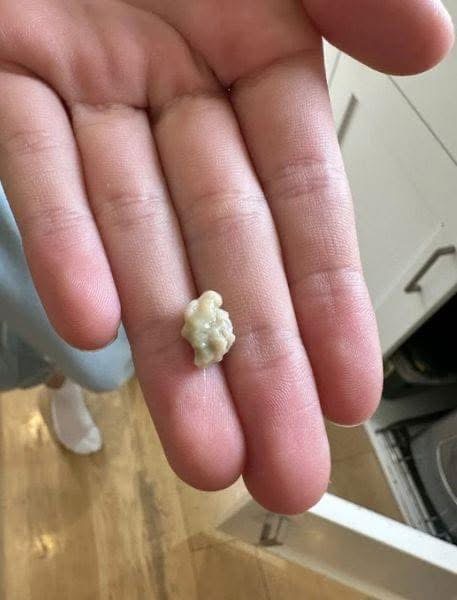 Everything you need to know about tonsil stones, the weird growths that look like pimples in your throat