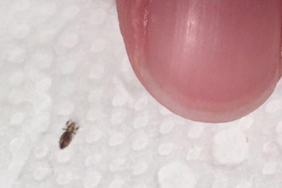 Head lice: How to get rid of them and stop them coming back