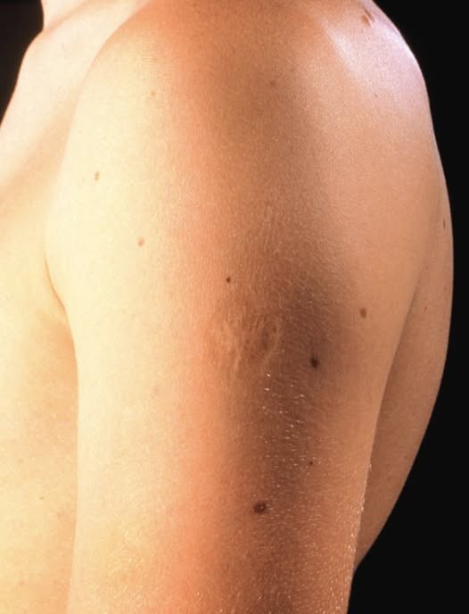 Smallpox vaccine scars: What they look like and why