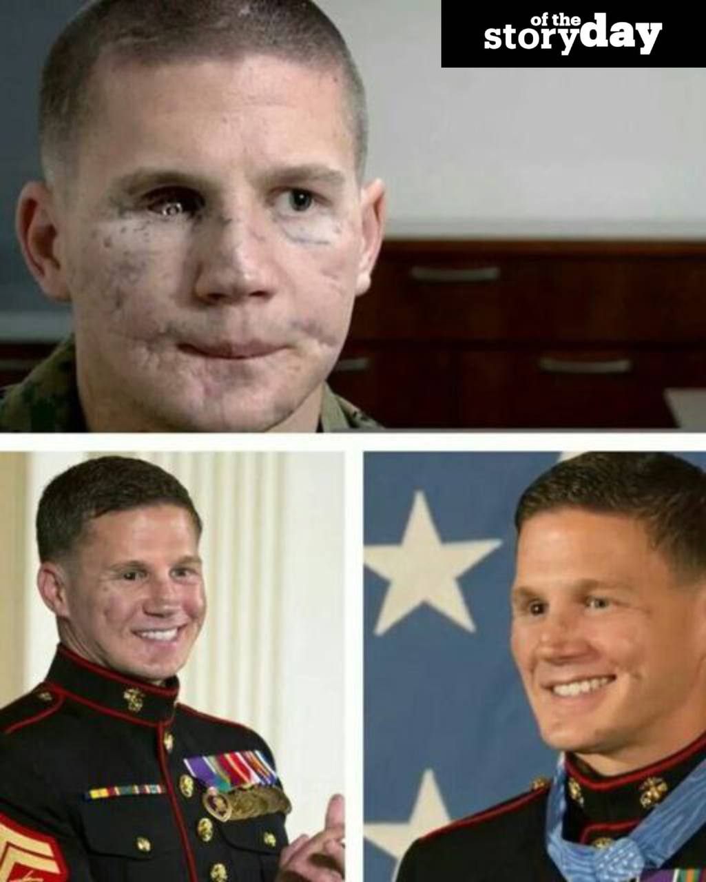 I HID MY FACE FOR YEARS—UNTIL THEY HANDED ME THAT MEDAL