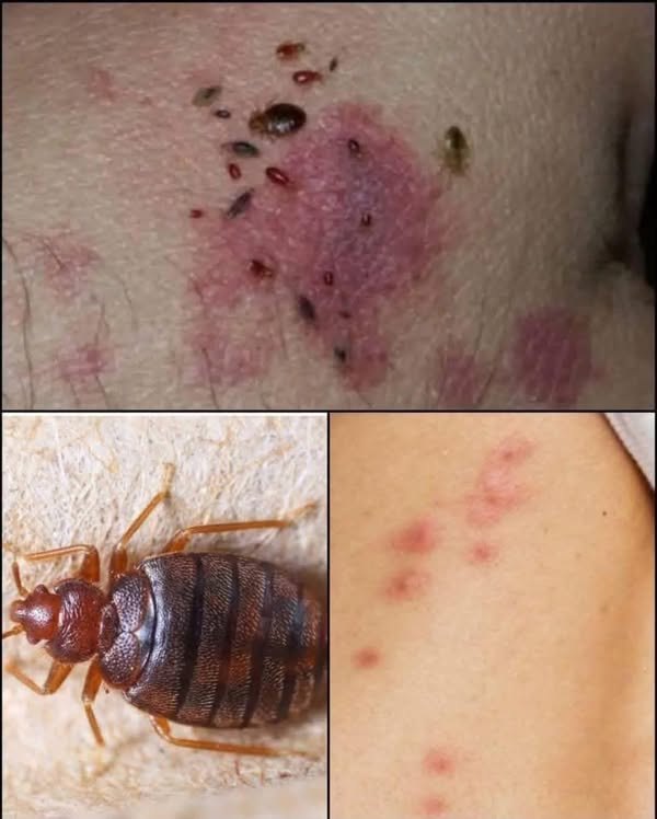 Understanding Scabies
