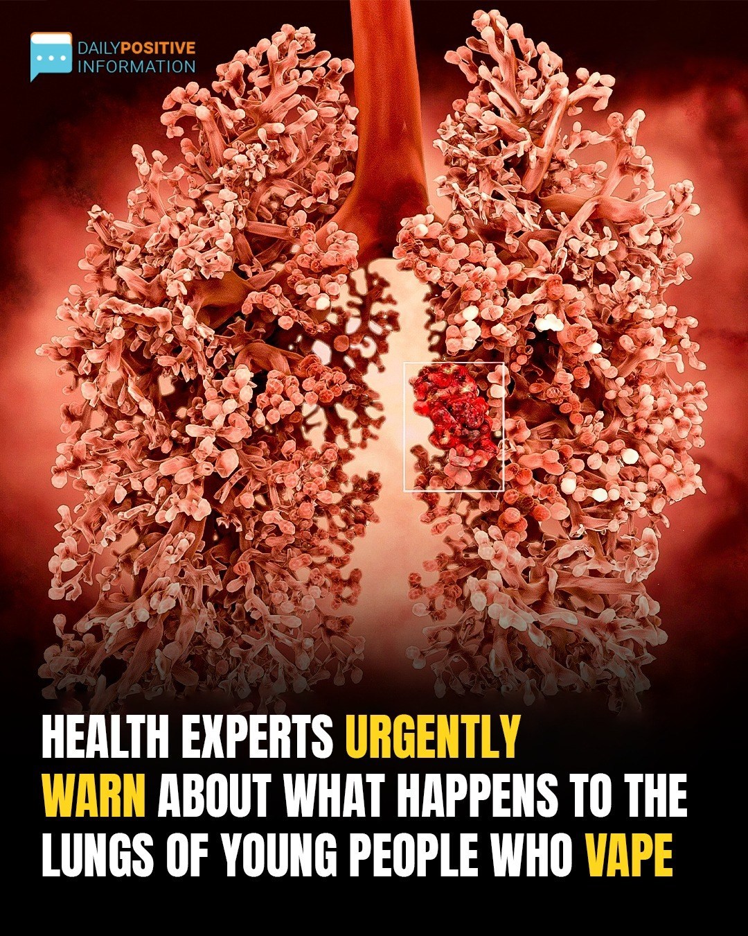 Doctors Sound Alarm As ‘Popcorn Lung’ Linked To Vaping Sends Teens To ER