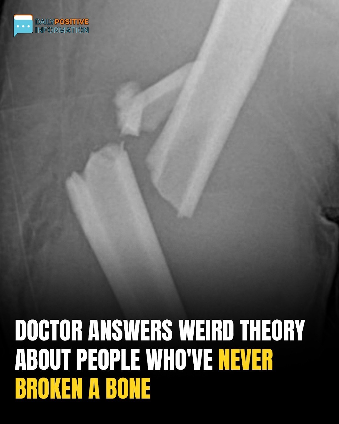 Doctor Breaks Down Bizarre Theory About People Who’ve Never Broken A Bone