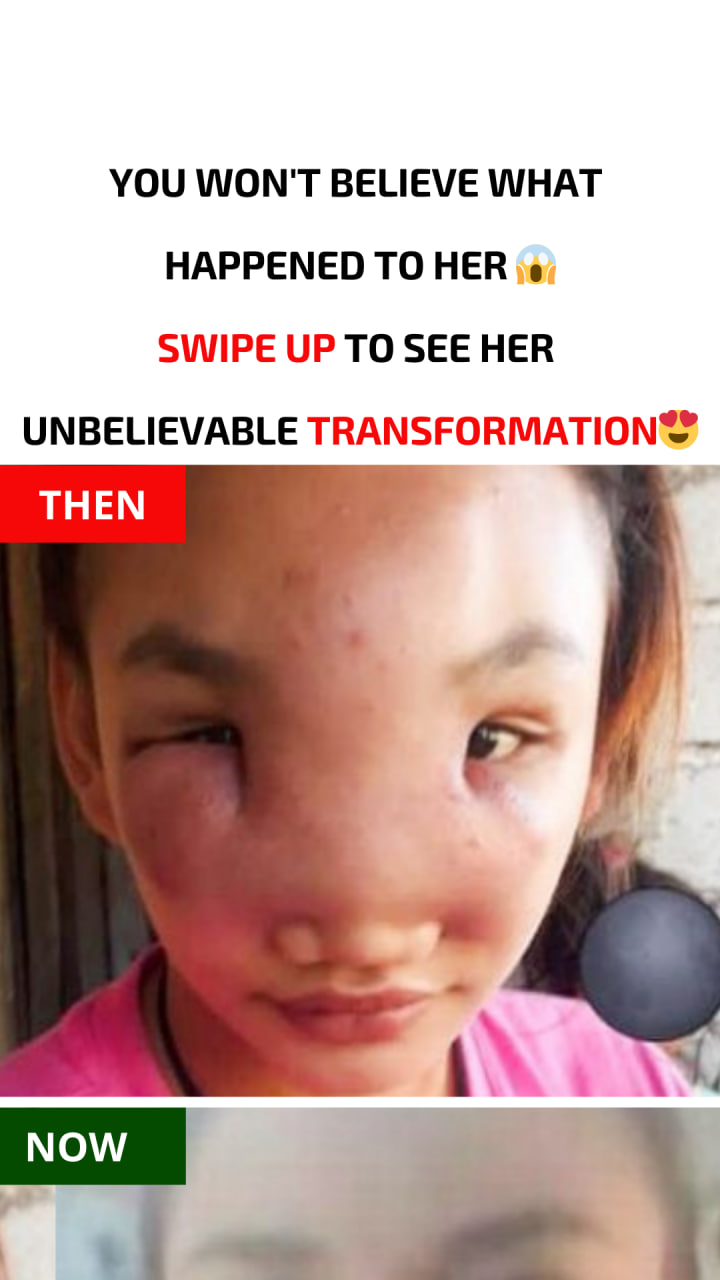 A spot on the nose of a girl who is 17 years old causes her to lose her vision…