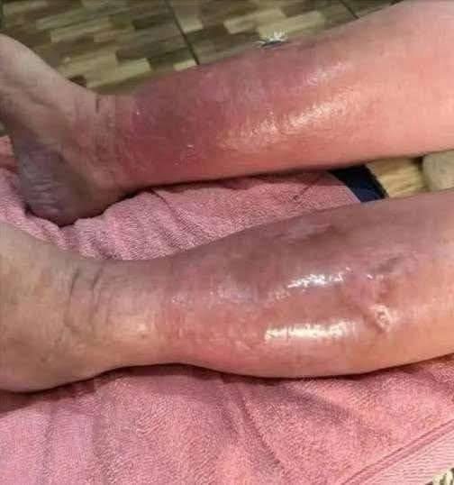 How I Got Rid of Swollen Ankles, Feet, and Legs — Without Medications