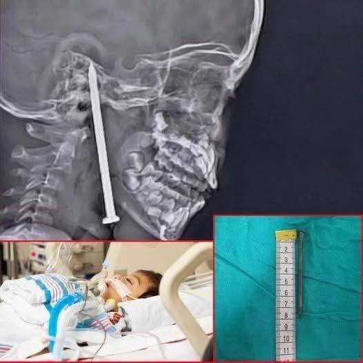 Year-Old Boy Survives After 3-Inch Nail Pierces His Brain In Shocking Playground Accident!!!