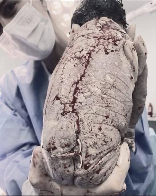 Baby born with an DIU peg… See more