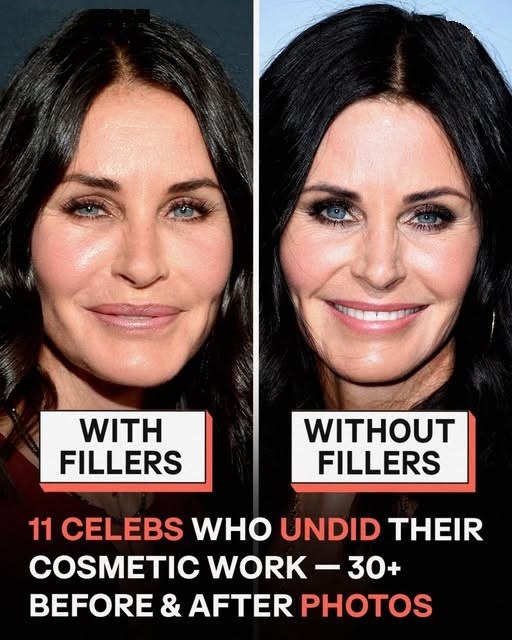 11 Celebrities Who Chose to Remove Their Fillers – Before and After Pictures