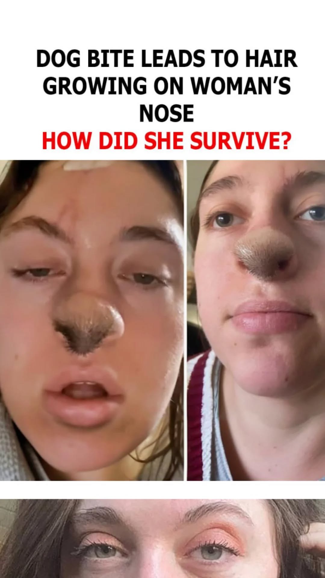 From Bite to Bizarre: Woman Grows Nose Hair Following Dog Attack!