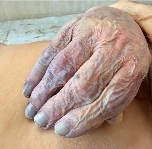 HT10. 3 Signs on Your Hands That Could Indicate Heart Disease or Cancer