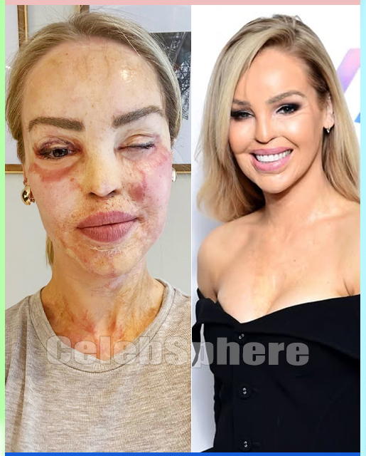 “I Survived What Was Meant to Destroy Me”: Inside Katie Piper’s Final Reconstructive Surgery and the Unbreakable Spirit Behind Her Remarkable Journey