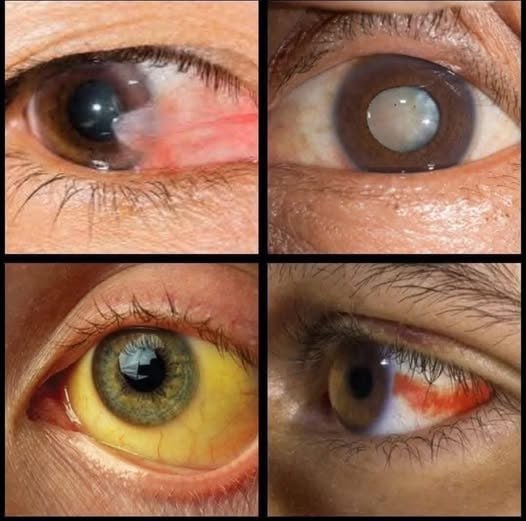 8 Things Your Eyes Say About Your Health! If you have any of these signs, you need to see a doctor right now!