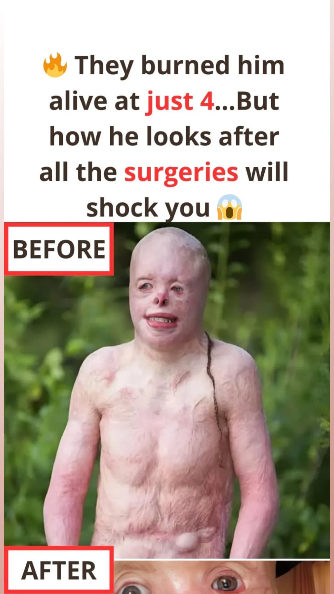 The Boy Who Endured the Fire: Rebuilding Life After 95% Burns — His Journey Redefines True Strength