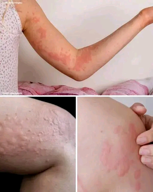 If Your Body Itches and These Bumps Appear on Your Skin… Here’s What It Could Mean