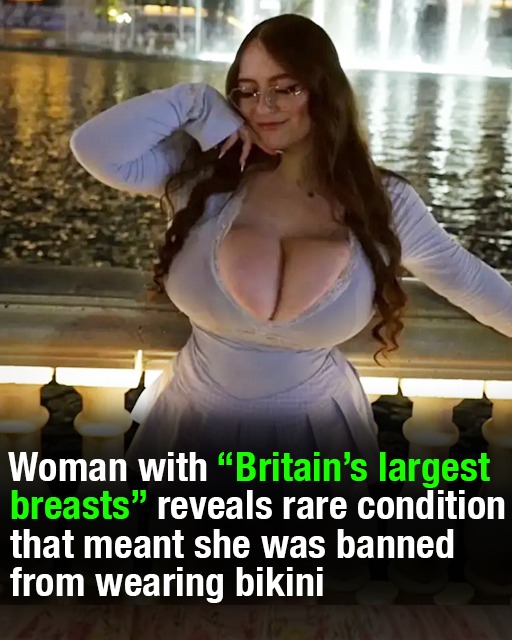 Woman with ‘Britain’s largest breasts’ reveals rare condition that meant she was banned from wearing bikini