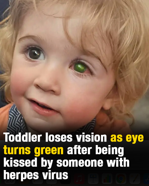 Toddlerโs eye โmelts awayโ after wrong person kissed him