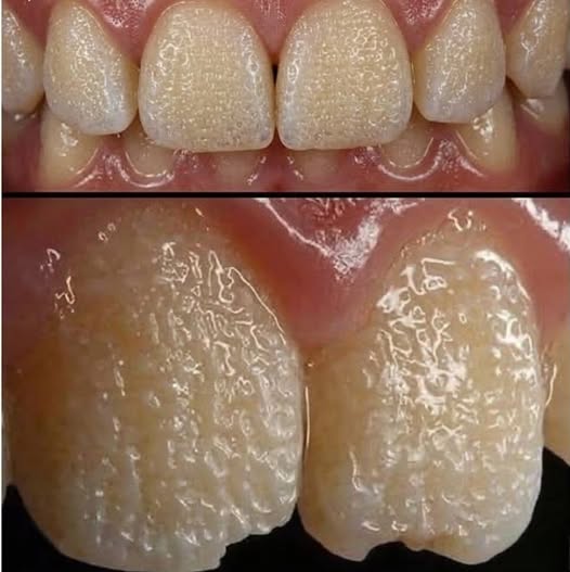 Be Careful! This Is What Can Happen to Your Teeth When You Eat Certain Everyday Foods and Drinks That Slowly Damage Enamel, Cause Staining, Increase Sensitivity, and Lead to Long-Term Dental Problems You Might Not Notice Until Its Too Late to Reverse the Effects!