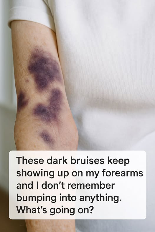 I keep noticing dark bruises on my forearms, but I have no memory of any injuries. What could this mean?