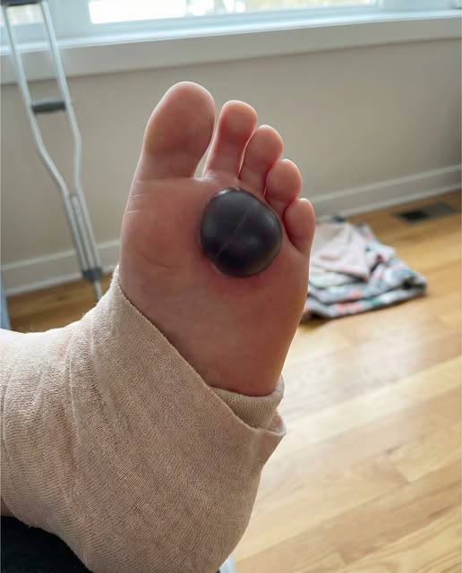 Blood Blisters: What They Are, Common Causes, and How to Care for Them