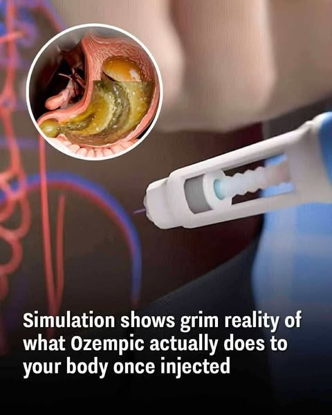 That’s true—leaving materials like gold needles in the body can have serious side effects.