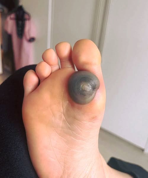 My Daughter Woke Up With a Large Spot on Her Foot and Is in Pain โ Iโm Not Sure What It Could Be