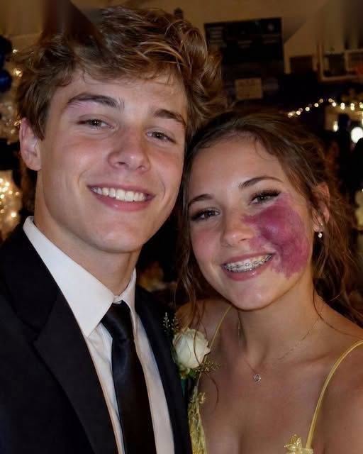 Only One Boy Asked Me to Prom Because No One Else Wanted to Due to the Birthmark on My Face – Everyone Laughed Until an Officer Walked Into the Hall